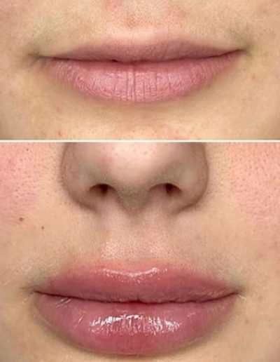 Julian-Reese-Spa-botox-fillers-O'Fallon-MO-Before-After-Examples