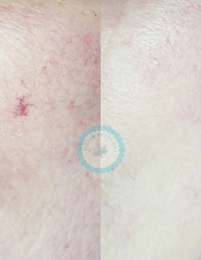 Julian-Reese-Spa-vein-away-removal-O'Fallon-MO-Before-After-Examples