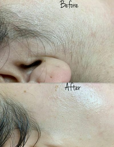 Julian-Reese-Spa-Laser-Hair-Removal-O'Fallon-MO-Before-After-Examples