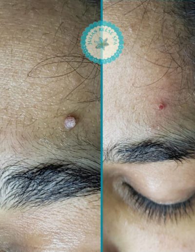 Julian-Reese-Spa-blemish-vessel-removal-O'Fallon-MO-Before-After-Examples