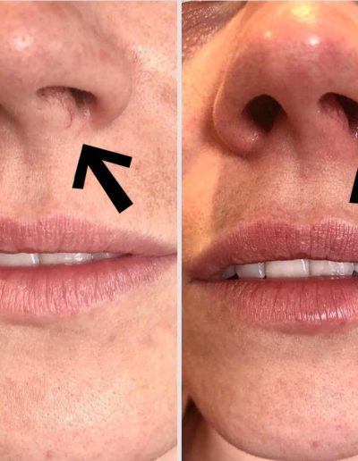 Julian-Reese-Spa-facial-vein-removal-O'Fallon-MO-Before-After-Examples