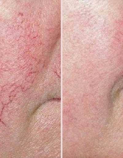 Julian-Reese-Spa-vein-away-removal-O'Fallon-MO-Before-After-Examples