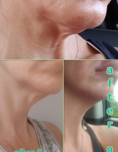 reduce loose skin - anti aging skin treatment