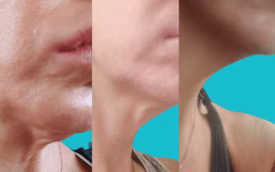 Neck Anti-aging For Loose Skin